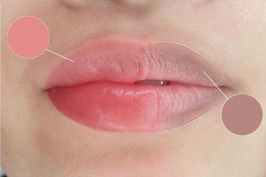 Khử thâm môi bằng Laser có nên không? Giá khử thâm môi 2024